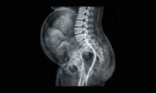 How to Relieve Sciatic Nerve Pain While Pregnant?